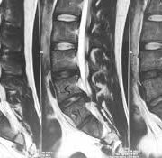 Causes, symptoms and treatment of herniated disc