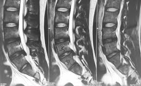 Causes, symptoms and treatment of herniated disc